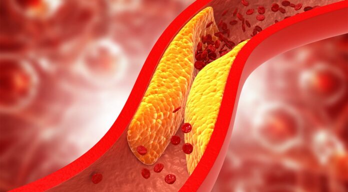 Efectos Colesterol Alto